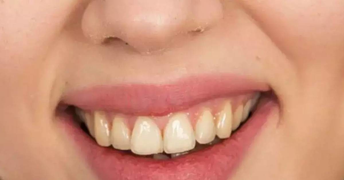 Teeth Whitening Powerful Combination दांतों को चमकदार और सफेद बनाने का