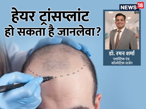 हेयर ट्रांसप्लांट के दौरान खोपड़ी के कुछ हिस्सों से बाल गंजेपन वाली जगह पर ट्रांसप्लांट किए जाते हैं.