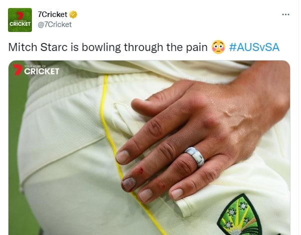 Mitchell Starc did not give up bowling even after being injured, blood came out of his finger (see picture)