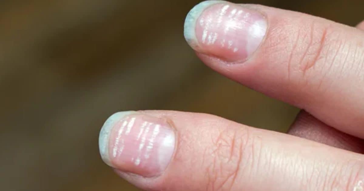 White Spots on Nails: Causes and Treatment Options