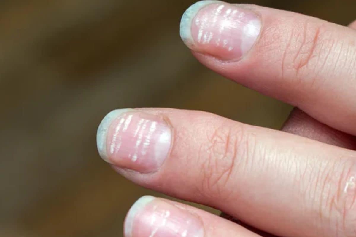 Myths busted: What those white spots on your nails really mean - 9Coach
