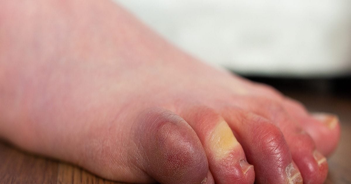 सर्दी में उंगलियों में आ रही सूजन, छोटी सी गलती पड़ रही भारी, करें ये