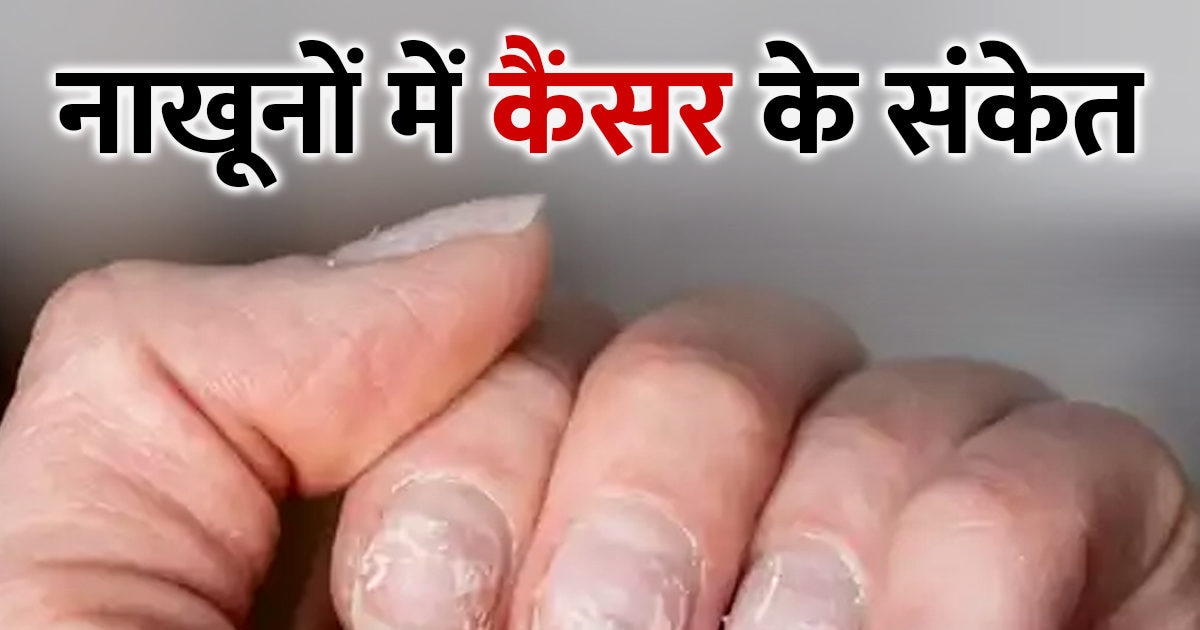 Nails can give signs of serious disease cancer, effect is also visible on hands, get diagnosed immediately