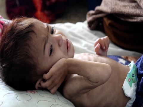 अफगानिस्‍तान में लाखों बच्‍चे और माताएं कुपोषित हैं. (फोटो- CNN) 