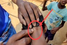 بچہ بولنے میں کمزور تھا، لیڈی ٹیچر نے جلتی ہوئی ماچس کی چھڑی سے طالبہ کی گردن پر داغ دیا، کارروائی کا مطالبہ