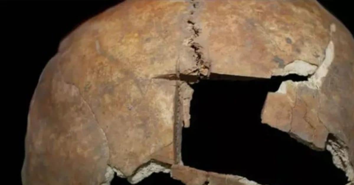 Brain surgery was done thousands of years ago, but it was not successful, scientists were also surprised by the revelation!