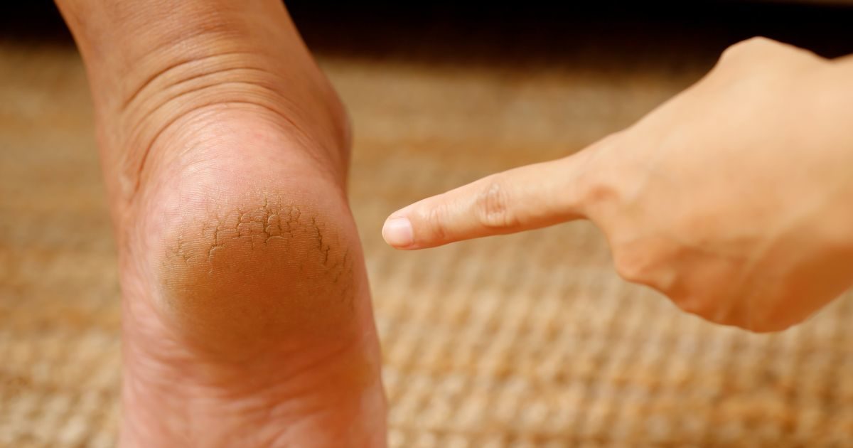 Troubled by cracked heels, make foot cream at home like this, skin will become soft and pink overnight
