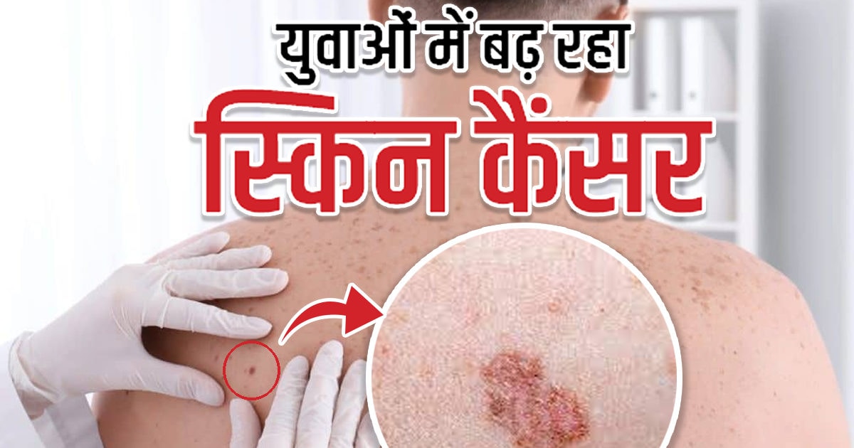 Mole or mark on the body, is it cancer?  This is how you can identify