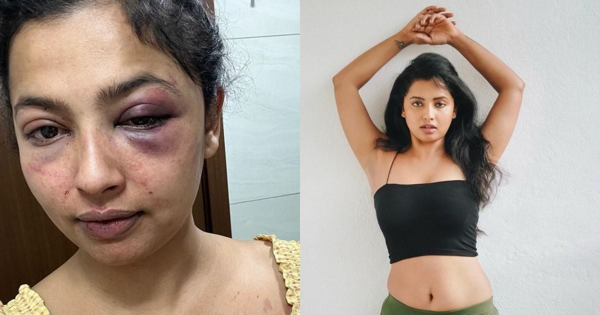 सूजी आंख, शरीर पर गहरे चोट के निशान, मलयालम एक्ट्रेस की बॉयफ्रेंड ने की बेरहमी से पिटाई, पहचानना मुश्किल