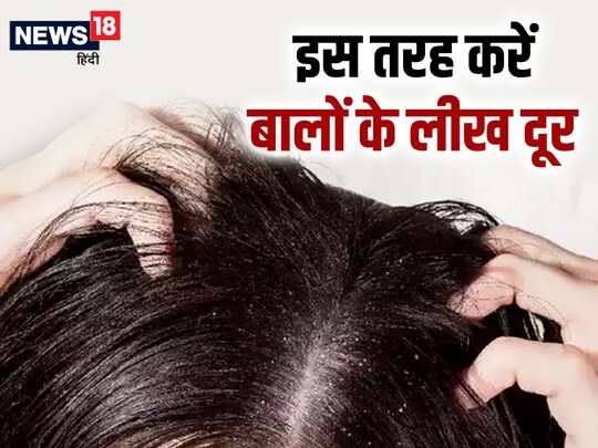 जूं की तरह लीख का आसानी से बालों से नहीं निकाला जा सकता.