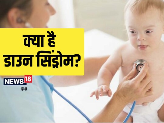 डाउन सिंड्रोम से हर साल लाखों बच्चे प्रभावित होते हैं.