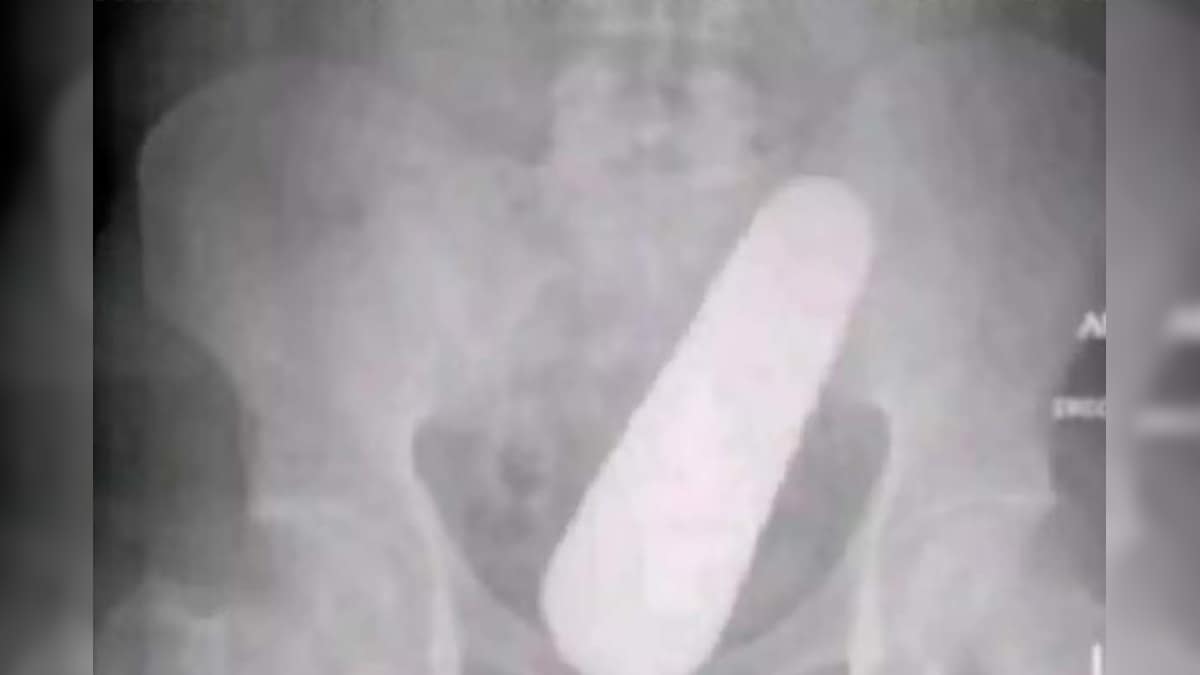 ऑपरेशन कर पेट से निकाला खीरा, डॉक्टर बोले- कैसे पहुंचा? मरीज ने दिया चौंकाने वाला जवाब