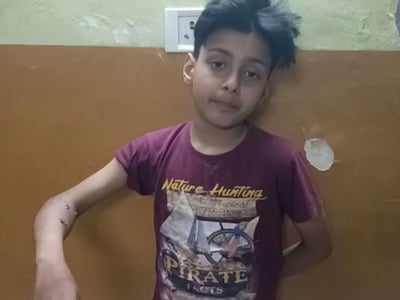Ghaziabad Pitbull Attack: 9 साल के मासूम पर पिटबुल ने किया हमला, बुरी तरह काटा 