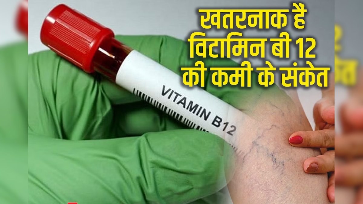 चुपके से आकर शरीर को खोखला कर देती है विटामिन बी 12 की कमी, दिखते हैं ये 5 डरावने संकेत, भारतीयों में स्थानीय महामारी
