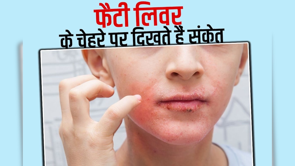 चेहरे पर भी नज़र आ सकते हैं फैटी लिवर बीमारी के लक्षण, 5 संकेतों से कर सकते हैं पहचान, रहें सतर्क