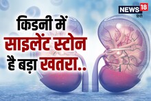 Kidney Stones: Silent stones lying in the kidney can cause kidney failure, it will take only a few months, Dr. of AIIMS told the remedies