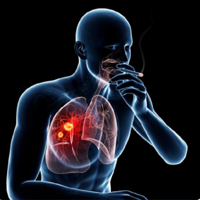 lungs, lungs disease, lungs disorder symptoms, early sign of lung disease, warning sign of lung disease, symptoms of lung disease, lung infection, signs of lung infection, lung infection treatment, lung infection treatment home remedy, lungs cleaning, lungs cleansing, How To Clean Lungs, lungs cleansing home remedies, effective ways to cleanse your lungs, lung infection, symptoms of lung infection, Chest infections, Lung Diseases, lungs diseases treatment, natural Tips for Healthy lungs, air pollution, lungs infections, foods for lungs, lungs food, फेफड़े, फेफड़े में इंफेक्शन, लंग्स की सफाई, Lifestyle, health, health tips, lungs