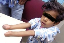 सफदरजंग अस्‍पताल के डॉक्‍टरों ने कर दिया कमाल, छोटी बच्‍ची को दिया तोहफा, पैरों से काटकर हाथों में लगा दीं उंगलियां