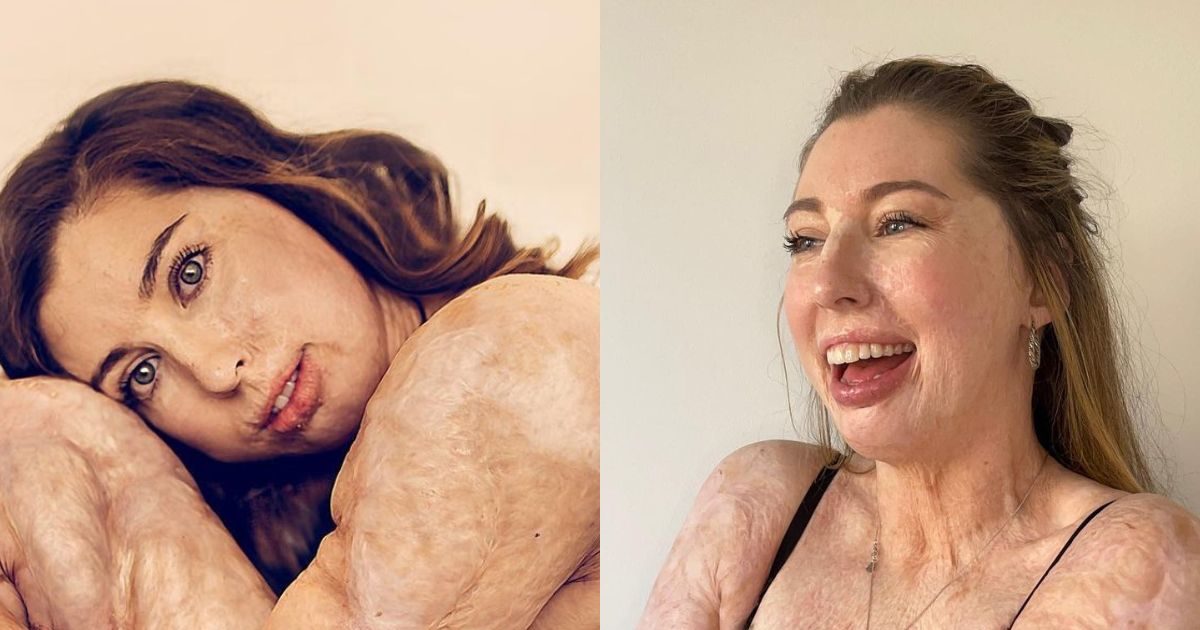 woman burn survivor