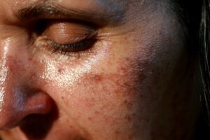 Pigmentation Remedies: पिगमेंटेशन से हैं परेशान, 5 आसान नुस्खे आएंगे काम, जल्द आ जाएगा चेहरे पर निखार