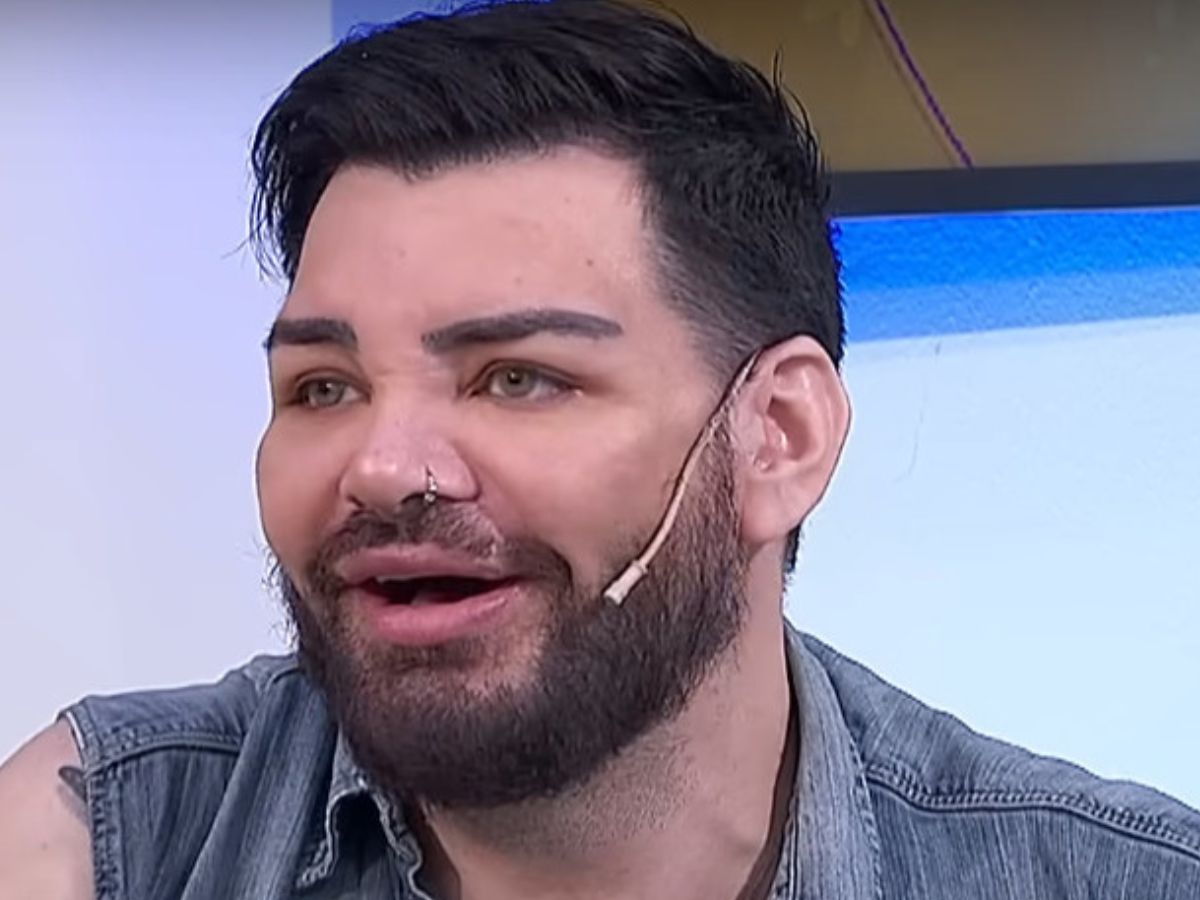 ricky martin face surgery