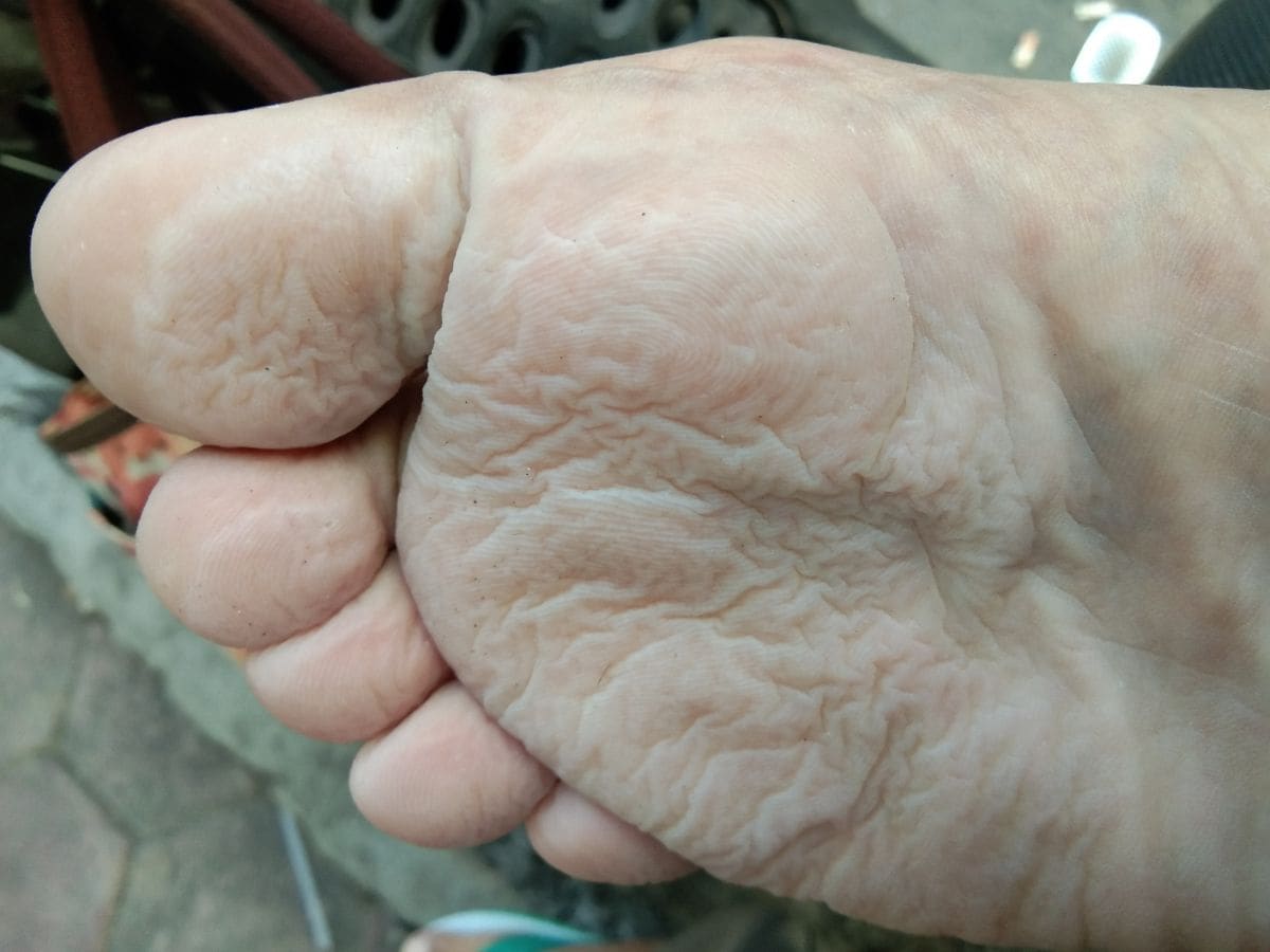why skin wrinkle in water 1
