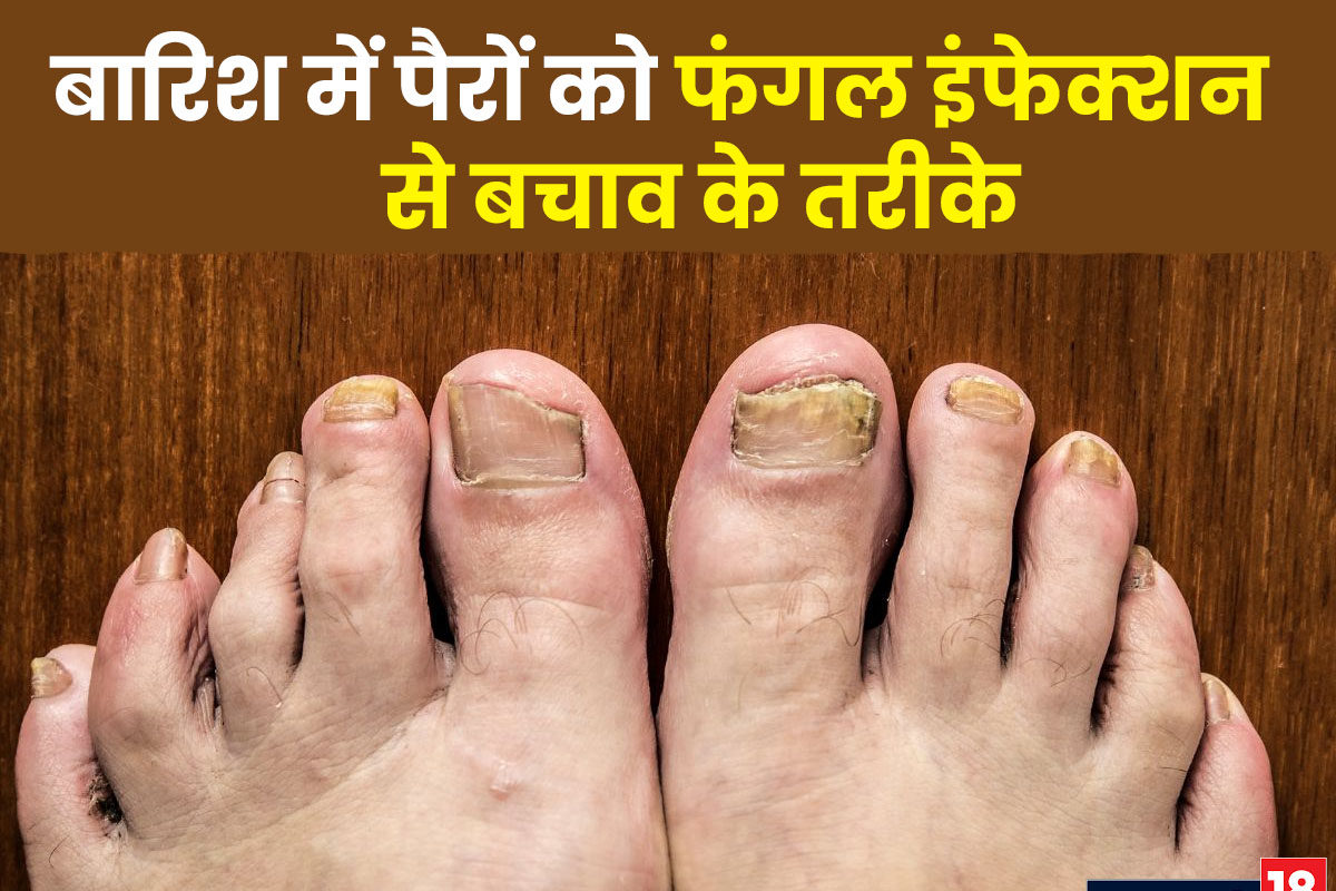 फंगल इन्फेक्शन (Fungal Infections In Hindi) : कारण, लक्षण, प्रकार, बचाव और  उपचार | What You Need To Know About Fungal Infections In Hindi