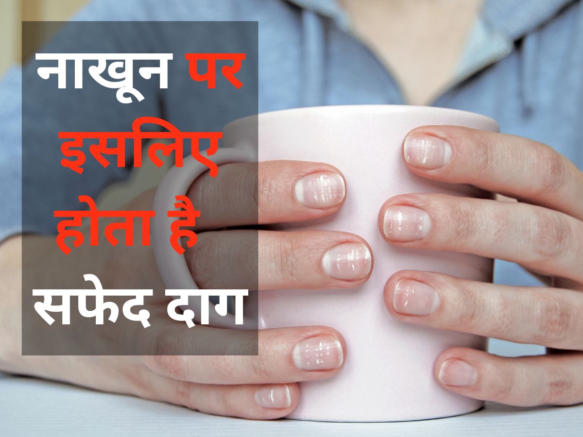 नेल फंगस (नाखून की बीमारी) के कारण, लक्षण और घरेलू इलाज - Nail Fungus  Symptoms and Home Remedies in Hindi