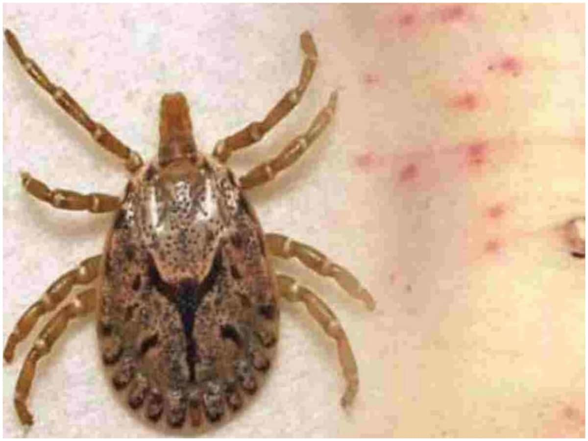 scrub typhus, What is scrub typhus, mysterious fever, scrub typhus increasing, symptoms of scrub typhus, treatment of scrub typhus, Dengue, Dengue Fever, Bush Typhus, Mouse, Mice, Bacteria, Fever, Farmers, Infection, Vaccine, Scrub Typhus Vaccine, Himachal Pradesh News, Uttarakhand News, Uttar Pradesh News, Rajasthan News, Maharashtra News, Odisha News, Madhya Pradesh News, News18, News18 Hindi, Knowledge News, Knowledge News Hindi