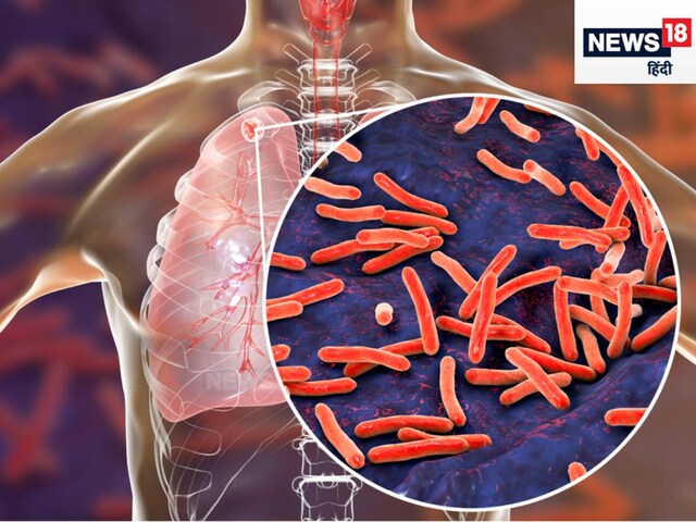 Latent TB: 9 नहीं 1 महीने में भी ठीक हो सकती है गुप्‍त टीबी! देश की 40% ...