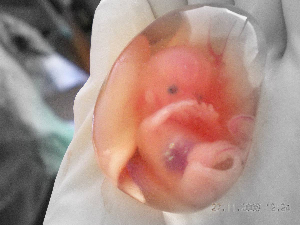 वेगवेगळ्या गर्भातून जुळी मुले, जुळे, टो गर्भाशय, दोन गर्भाशय असलेल्या महिला, गर्भधारणा, बाळ, गर्भ, 