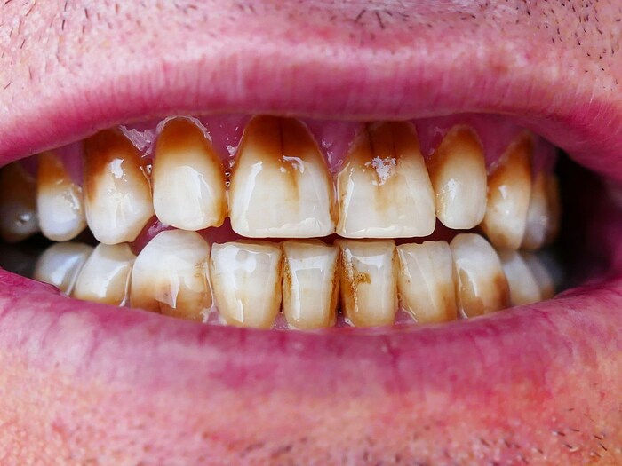 शरीर के साथ बालों को भी डैमेज करता है धुम्रपान, जल्दी आएगा बुढ़ापा 5 Canva