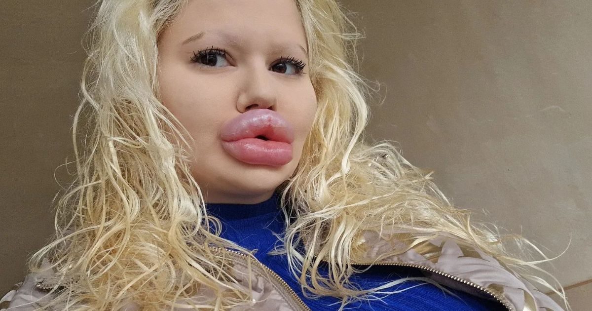 ‘I am not finding men for marriage…’, the girl with big lips expressed her sorrow, said – I want to increase my lips, but…