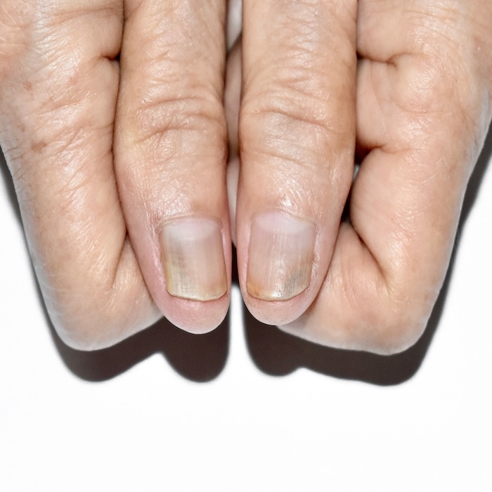 शरीर में दिखाई दें यह संकेत, तो समझ लें लीवर में है परेशानी 5 Canva