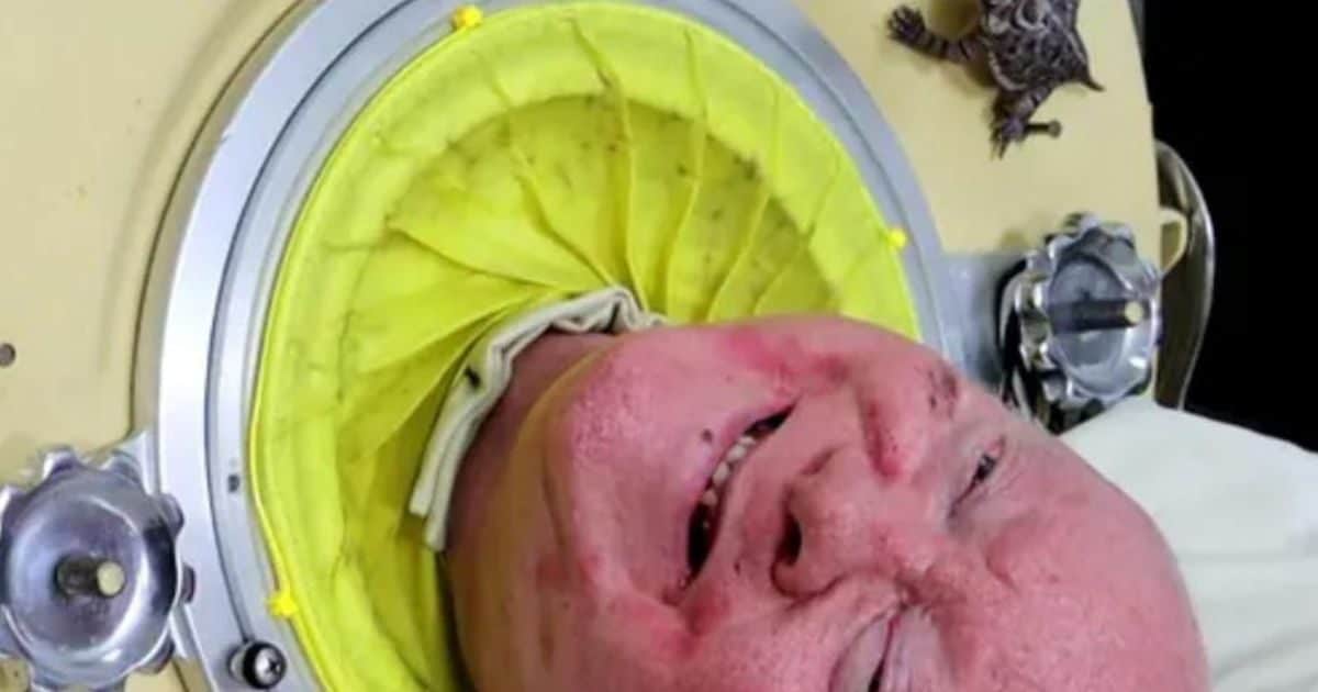 7 फीट लंबा 'लोहे का फेफड़ा', 70 सालों से सीने में लिए घूम रहा था शख्स, जी रहा था नर्क सी जिंदगी