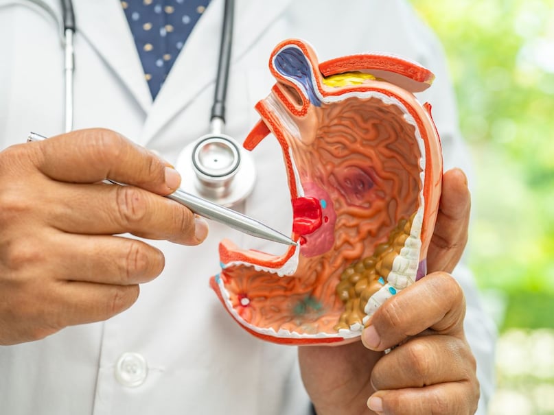 cancer, cancer reason, gastric cancer, gastric cancer symptoms, stomach cancer symptoms, signs of gastric cancer, cancer, cancer reason, gastric cancer, gastric cancer symptoms, stomach cancer symptoms, signs of gastric cancer,