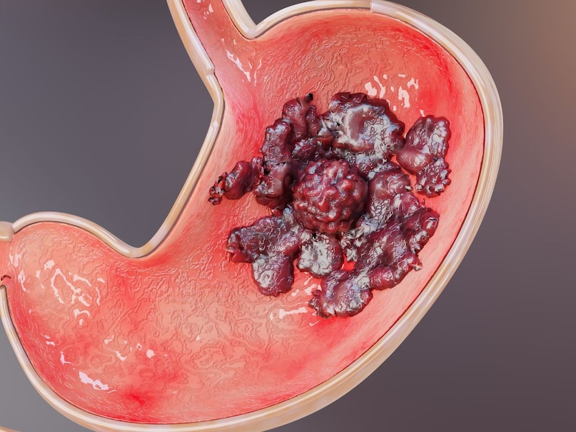 cancer, cancer reason, gastric cancer, gastric cancer symptoms, stomach cancer symptoms, signs of gastric cancer, cancer, cancer reason, gastric cancer, gastric cancer symptoms, stomach cancer symptoms, signs of gastric cancer,