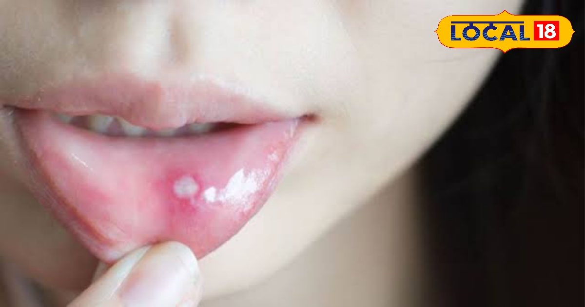 आपके मुंह में भी पड़ जाते हैं बार-बार छाले तो इस विटामिन की हो सकती है कमी