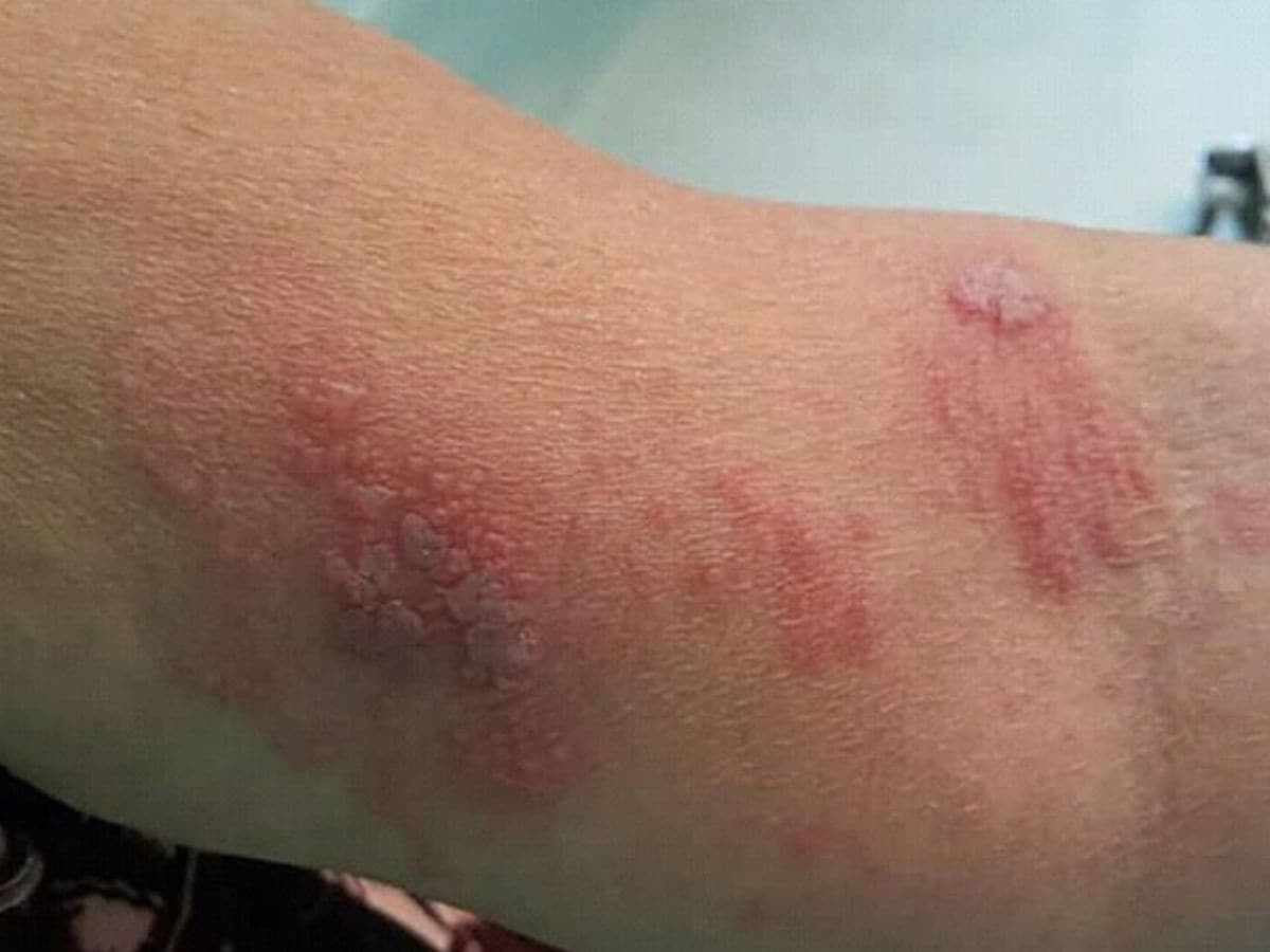 Weird infection, Dangerous plant, boy gets blisters after brushing a plant, poisonous plant, Hogweed, omg, amazing news, shocking news, England, summerset, 