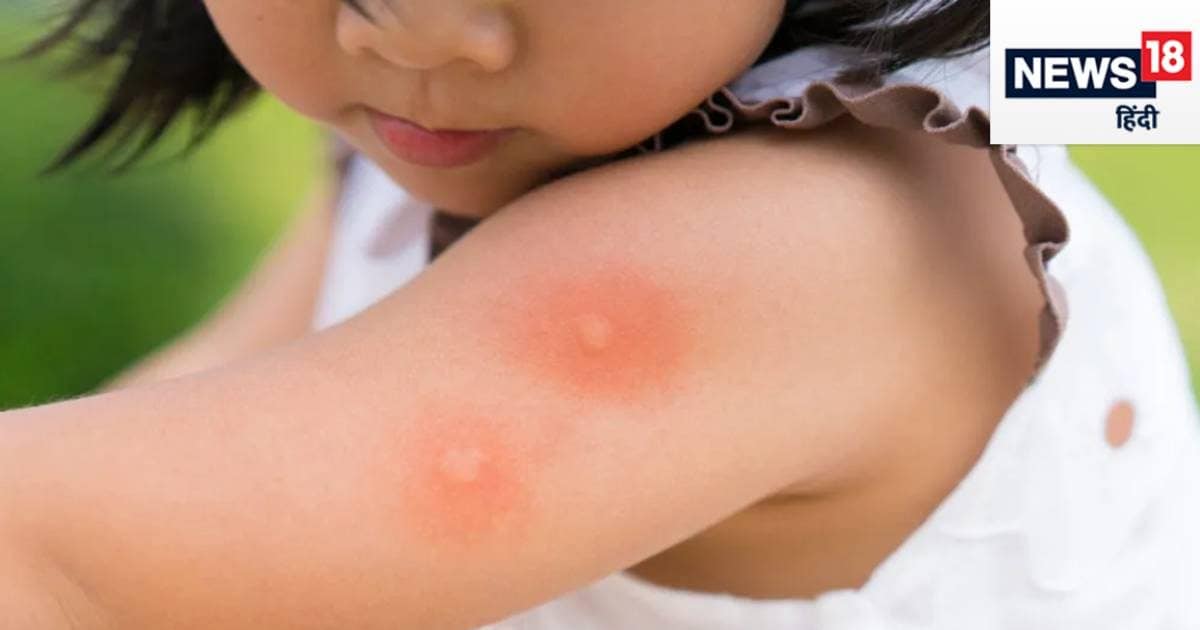बड़ों से ज्यादा बच्चों के लिए खतरनाक है डेंगू, जल्दी हो जाती है मौत, ये 5 चीज