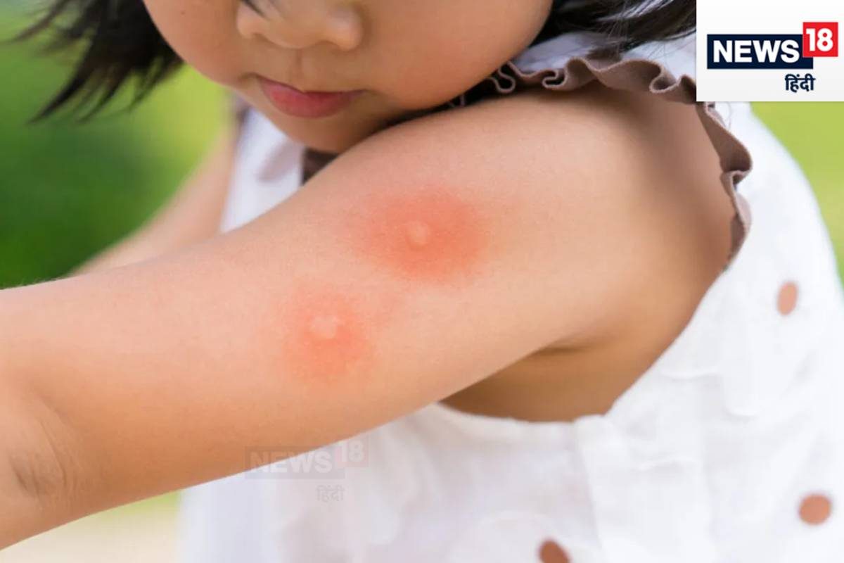 बड़ों से ज्यादा बच्चों के लिए खतरनाक है डेंगू जल्दी हो जाती है मौत ये 5 चीज