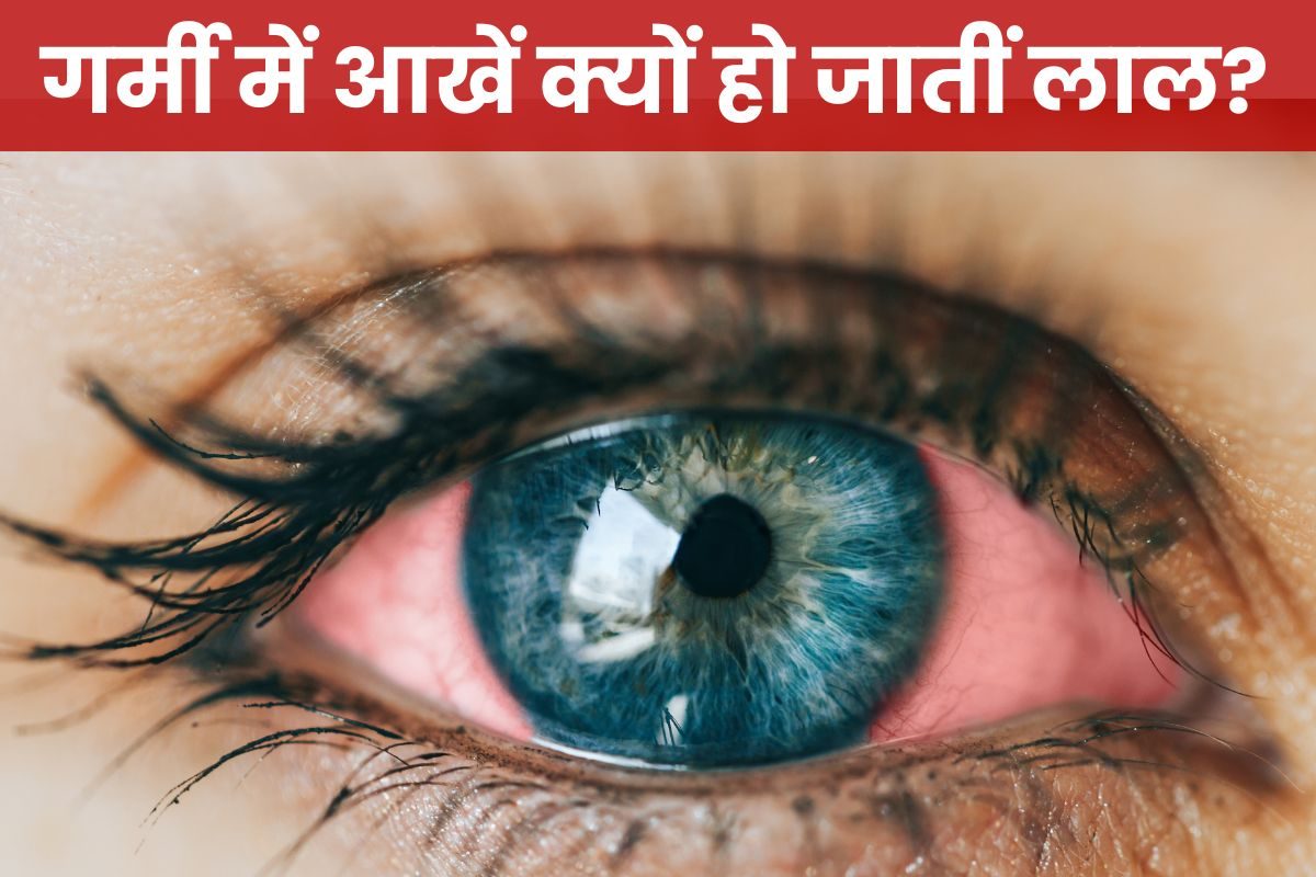 गर्मी में आंखें लाल क्यों हो जाती हैं डॉक्टर से जानें कारण और बचाव के उपाय