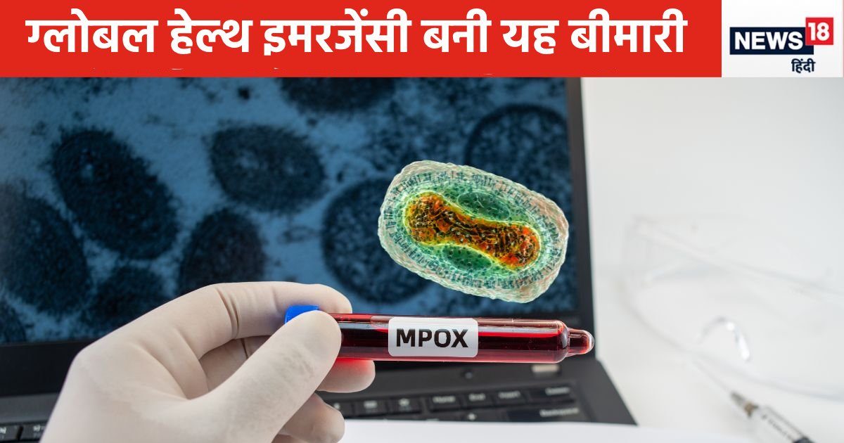 Mpox PCR Kits: भारत ने खुद बना लिया मंकीपॉक्स की जांच की RT-PCR किट, 40 मिनट में आएगा रिजल्ट