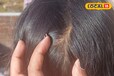 बालों में जुएं की समस्या से हैं परेशान, ऐसे करें उनका काम-तमाम