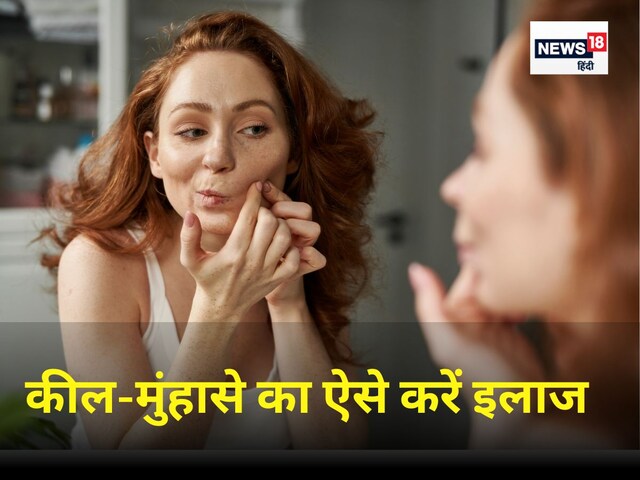 चेहरे से कील-मुंहासे को करना है क्लीन बोल्ड तो इन 5 तरीकों को आजमा लें