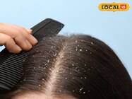 कपूर या एलोवेरा का ऐसे करें इस्तेमाल, आपके बालों में नहीं होंगे डैंड्रफ