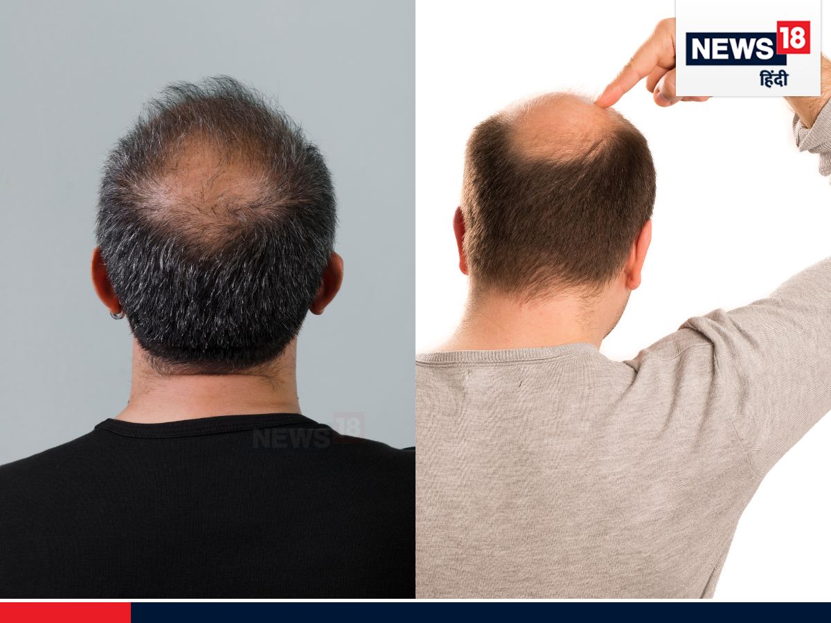 Men Hair Health Here Are The 5 Most Common Causes Behind Male Baldness