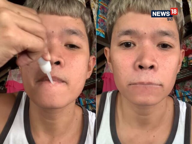 लड़के को सूझी मस्ती, सुपरग्लू से चिपका लिए होंठ, जब नहीं खुला मुंह, तो...