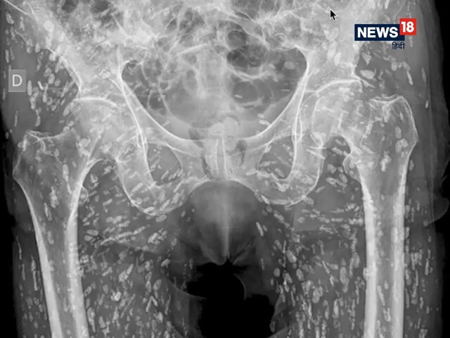 मामूली गलती से शख्स का हुआ बुरा हाल, शरीर में हुआ दर्द तो करवाया X-ray