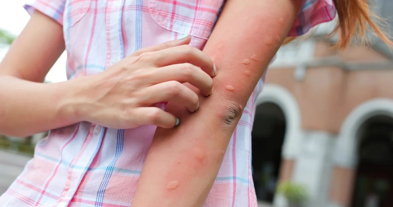 Mosquito Bite, Mosquito, Which Blood Group Person Attracts Mosquitoes, Do you know, mosquito bites, blood group, which blood group people are more likely to be bitten by mosquitoes, mosquitoes run away, mosquito bites, mosquito infestation in summer Mosquito Bite, Mosquito, Which Blood Group Person Attracts Mosquitoes, Do you know, mosquito bites, blood group, which blood group people are more likely to be bitten by mosquitoes, mosquitoes run away, mosquito bites, mosquito infestation in summer